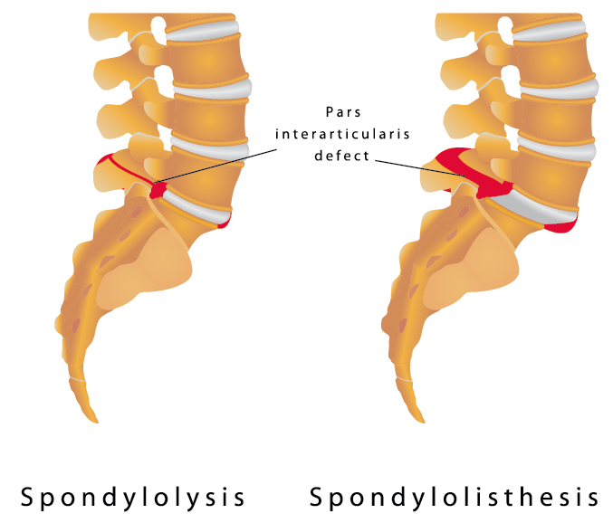 Spondylolisthesis Ainsworth Ambulatory Surgery Center