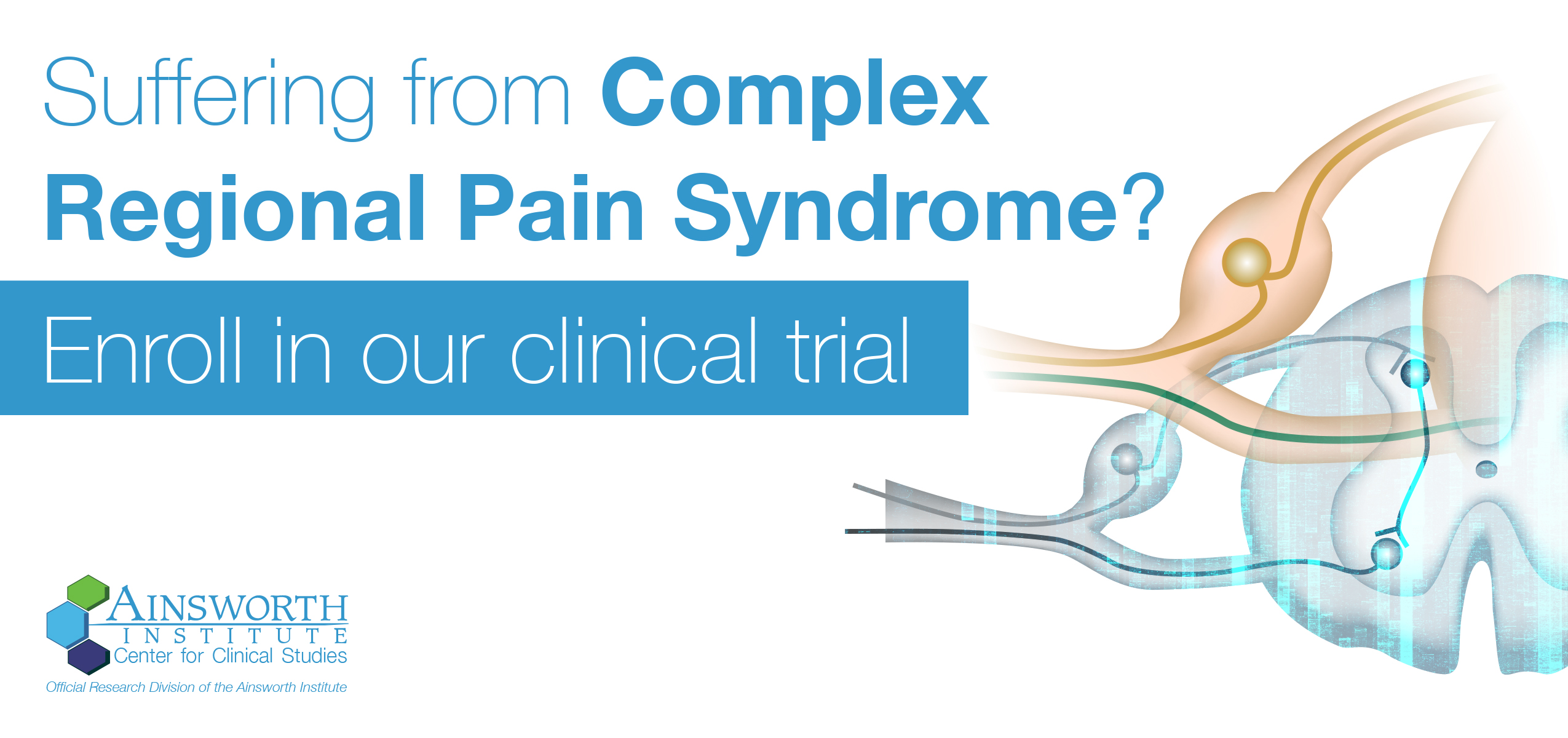 DRG Stimulation, CRPS treatment, complex regional pain syndrome treatment, RSD treatment, reflex sympathetic dystrophy treatment, clinical trial