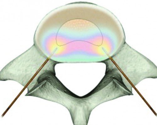 Biacuplasty Discogenic Pain