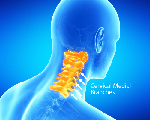 Cervical Medial Branch Block