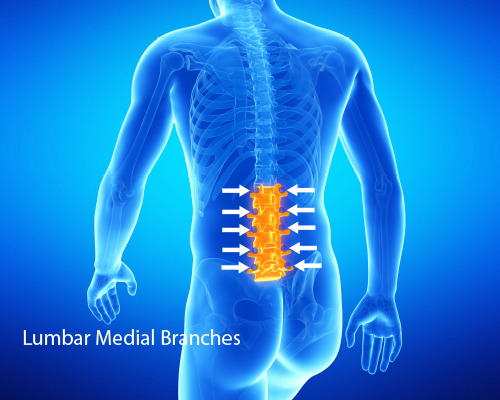 Lumbar Medial Branch Block