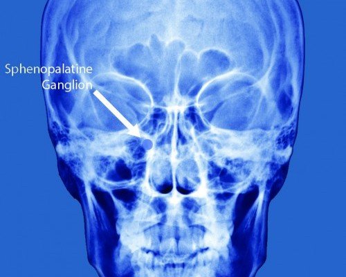 Sphenopalatine Ganglion Block