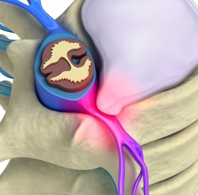 Herniated Disc New York NYC Treating herniated disc New York City NYC