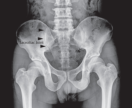 Sacroiliitis Low Back Pain, Sacroiliac Joint Pain