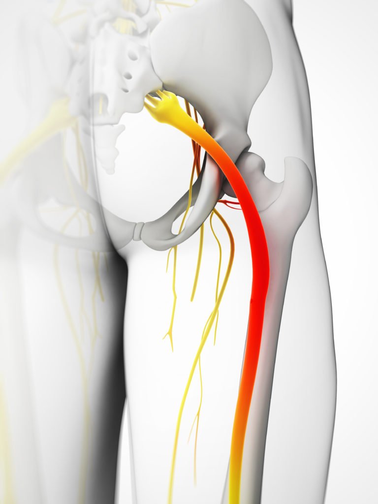 Sciatic Nerve Inflamed - Sciatica