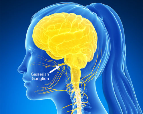 Facial Pain, Trigeminal Neuralgia, Atypical Facial Pain, Gasserian Ganglion Block, Trigeminal Nerve Bloc